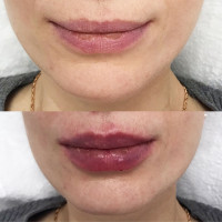 Объёмная контурная пластика губ